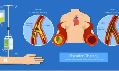 iv chelation therapy cost