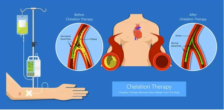 iv chelation therapy cost